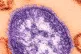 Measles
