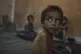 Yazan Abu Ful, a two-year-old malnourished child, sits at his family home in the Shati refugee camp in Gaza City, July 23, 2025