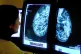 A consultant analyzing a mammogram